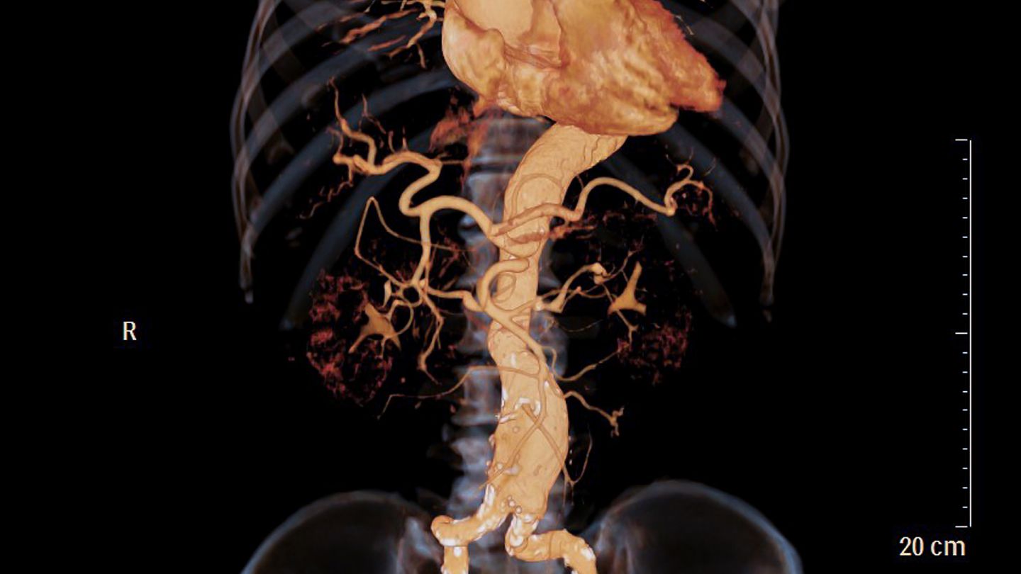 Bauchschlagader (Quelle: Getty Images/mr.suphachai praserdumrongchai) Bauchaortenaneurysma: das Farbbild einer menschlichen Bauchschlagader (Aorta).