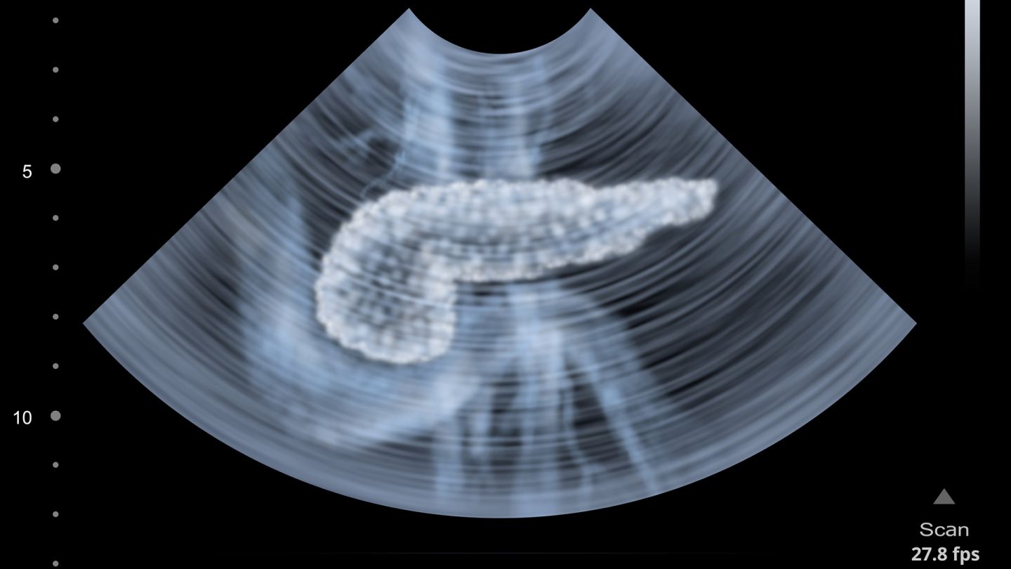 Bauchspeicheldruesenkrebs (Quelle: Getty Images/alex-mit) Bauchspeicheldrüsenkrebs: Ein Ultraschallbild, auf dem ein menschlicher Pankreas abgebildet ist.