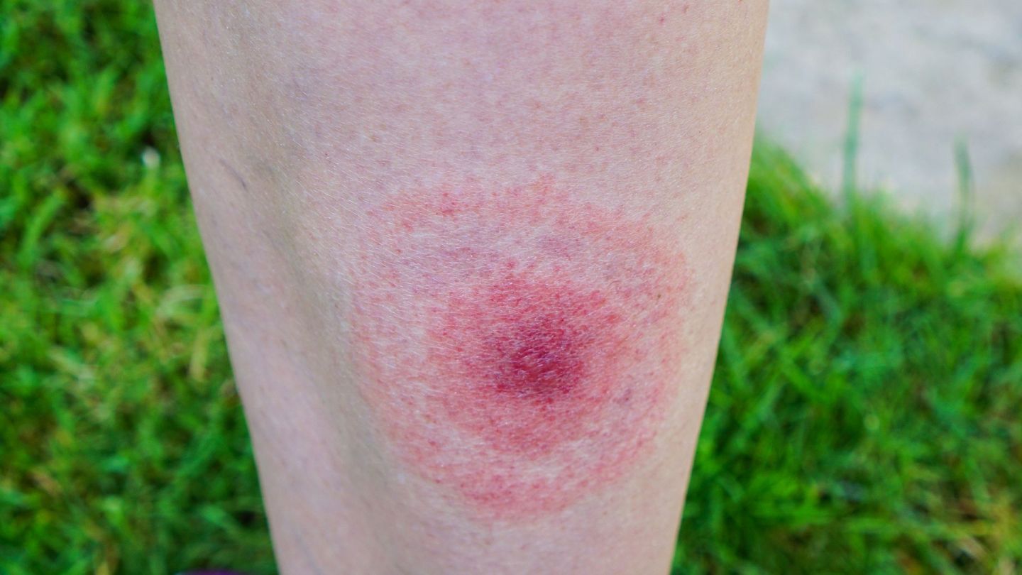 Zeckenstich mit Wanderröte am Bein (Quelle: Getty Images/anakopa) Borreliose: Ein Bein, das nach einem Zeckenstich eine rundliche Hautrötung aufweist, die sogenannte Wanderröte.