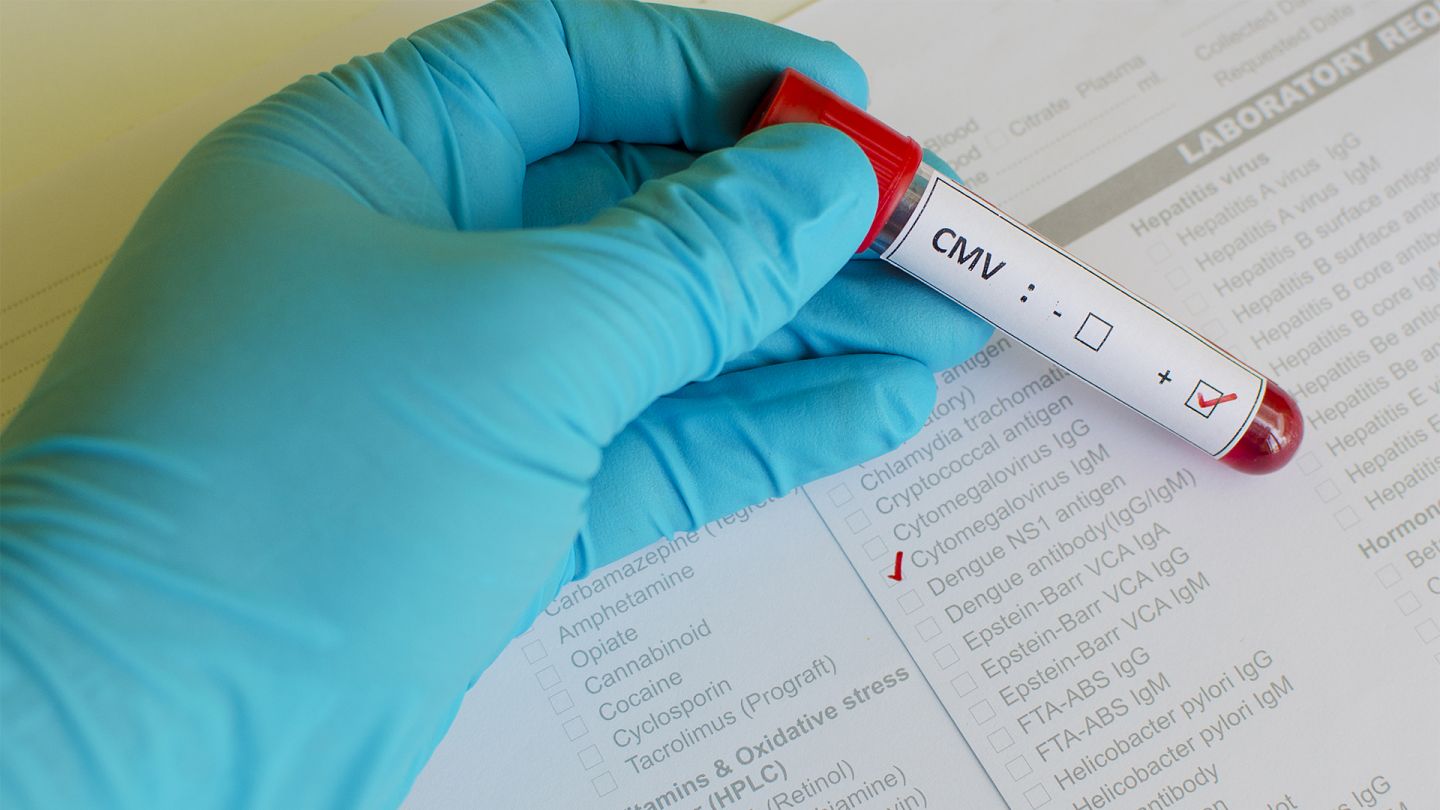 Cytomegalievirus-Infektion (Quelle: Getty Images/jarun001) Cytomegalovirus-Infektion: Eine Hand mit einem blauen Schutzhandschuh hält ein Teströhrchen über ein Formular, auf dem ein Häkchen bei Cytomegalovirus IgM gesetzt ist. Auf dem Röhrchen klebt ein Aufkleber mit dem Ergebnis CMV positiv.