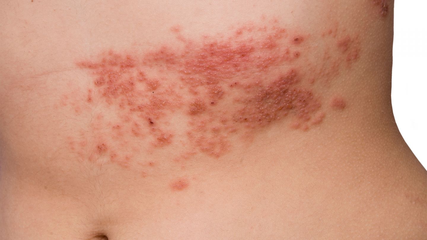 Gürtelrose (Quelle: iStock/franciscodiazpagador) Ein nackter Frauenoberbauch mit dem Hautausschlag, der typisch ist für eine Gürtelrose.