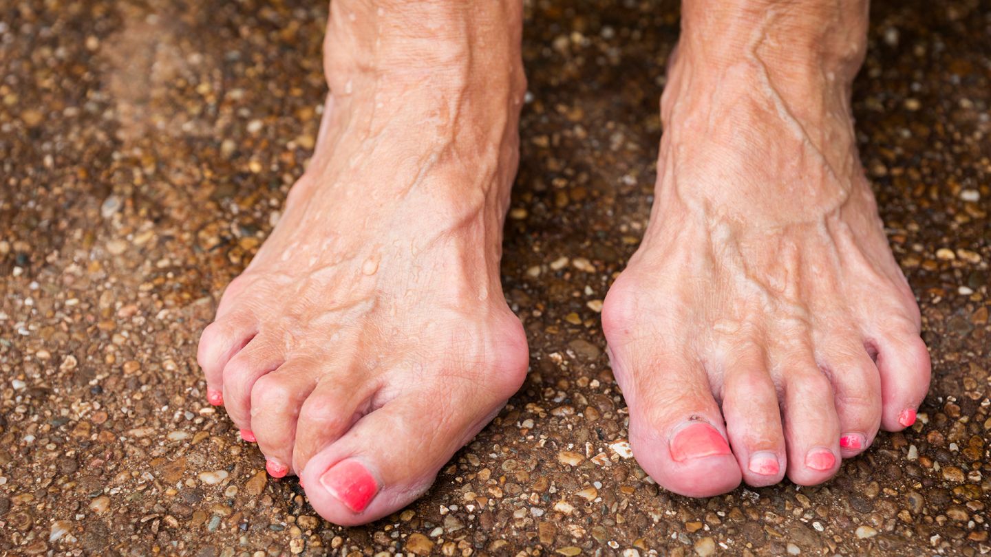 Hallux Valgus (Quelle: Getty Images/wanderluster) Hallux Valgus: Zwei Frauenfüße stehen auf dem Boden. An einem Fuß sind die Großzehen gespreizt, haben eine Fehlstellung.