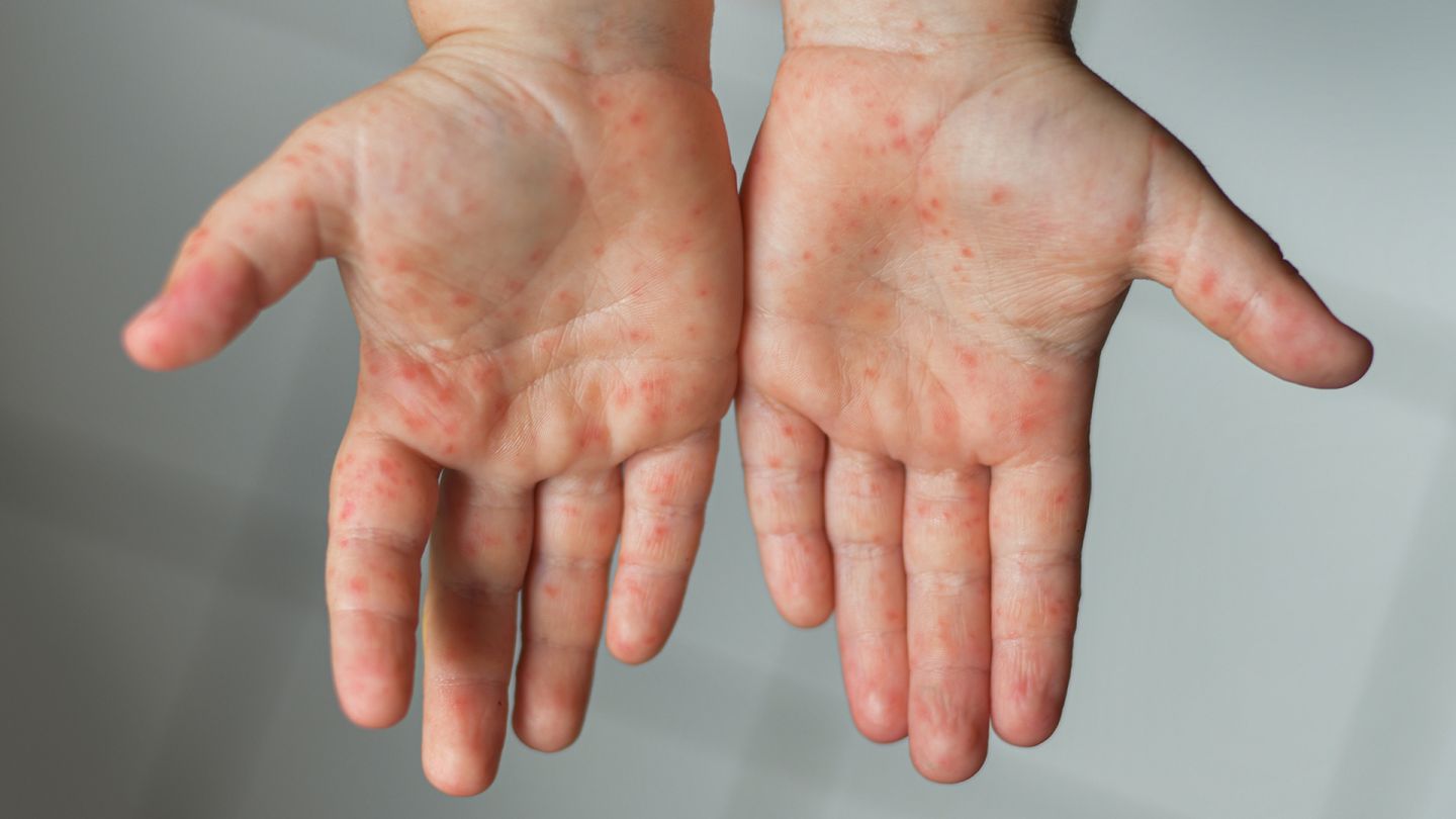 Hand-Fuß-Mund-Krankheit (Quelle: Getty Images/kipgodi) Hand-Fuß-Mund-Krankheit: Bläschenartige Wunden auf den Händen eines Kindes.