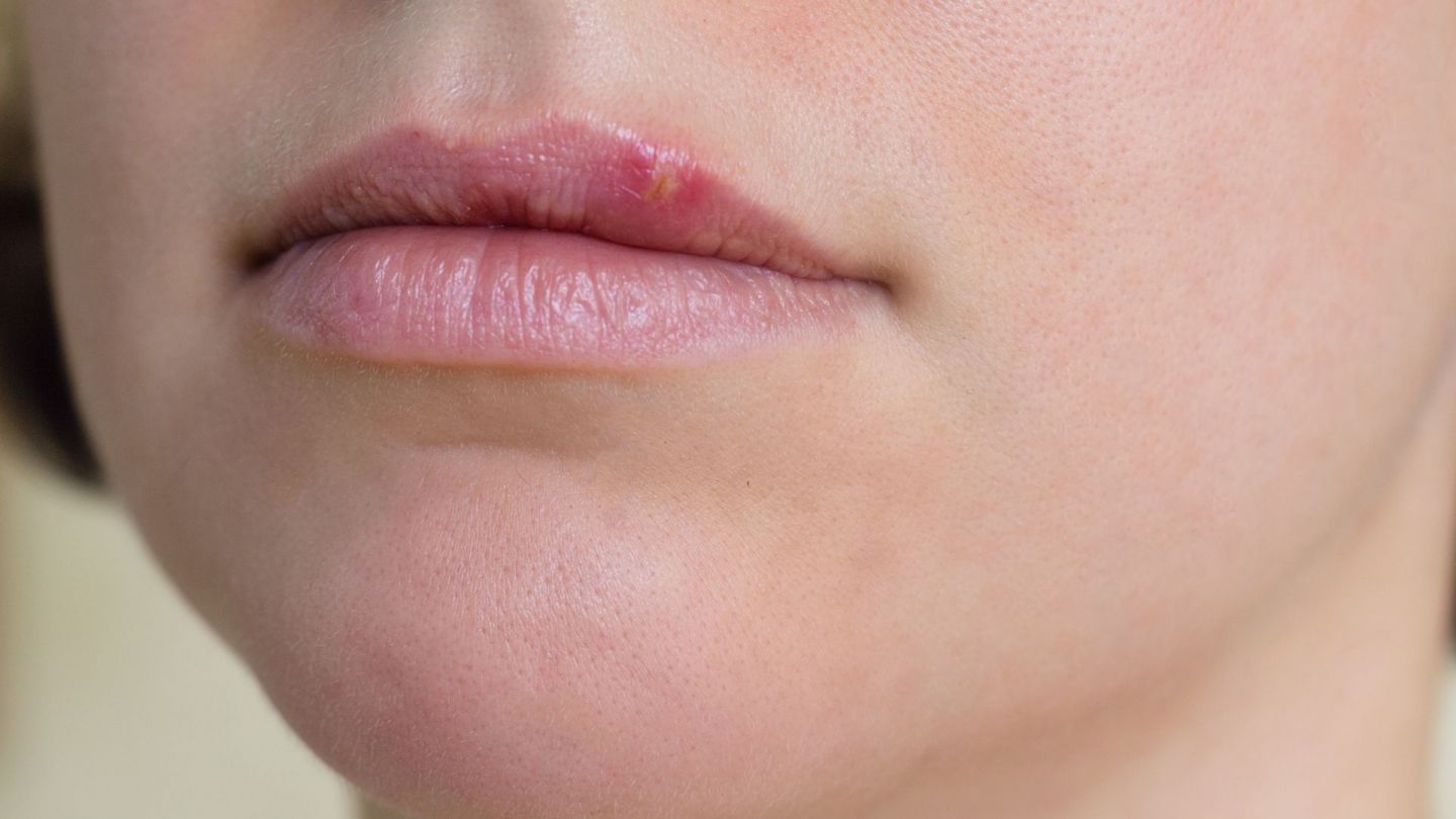 Lippenherpes Ursachen Folgen Behandlung Gesund Bund De