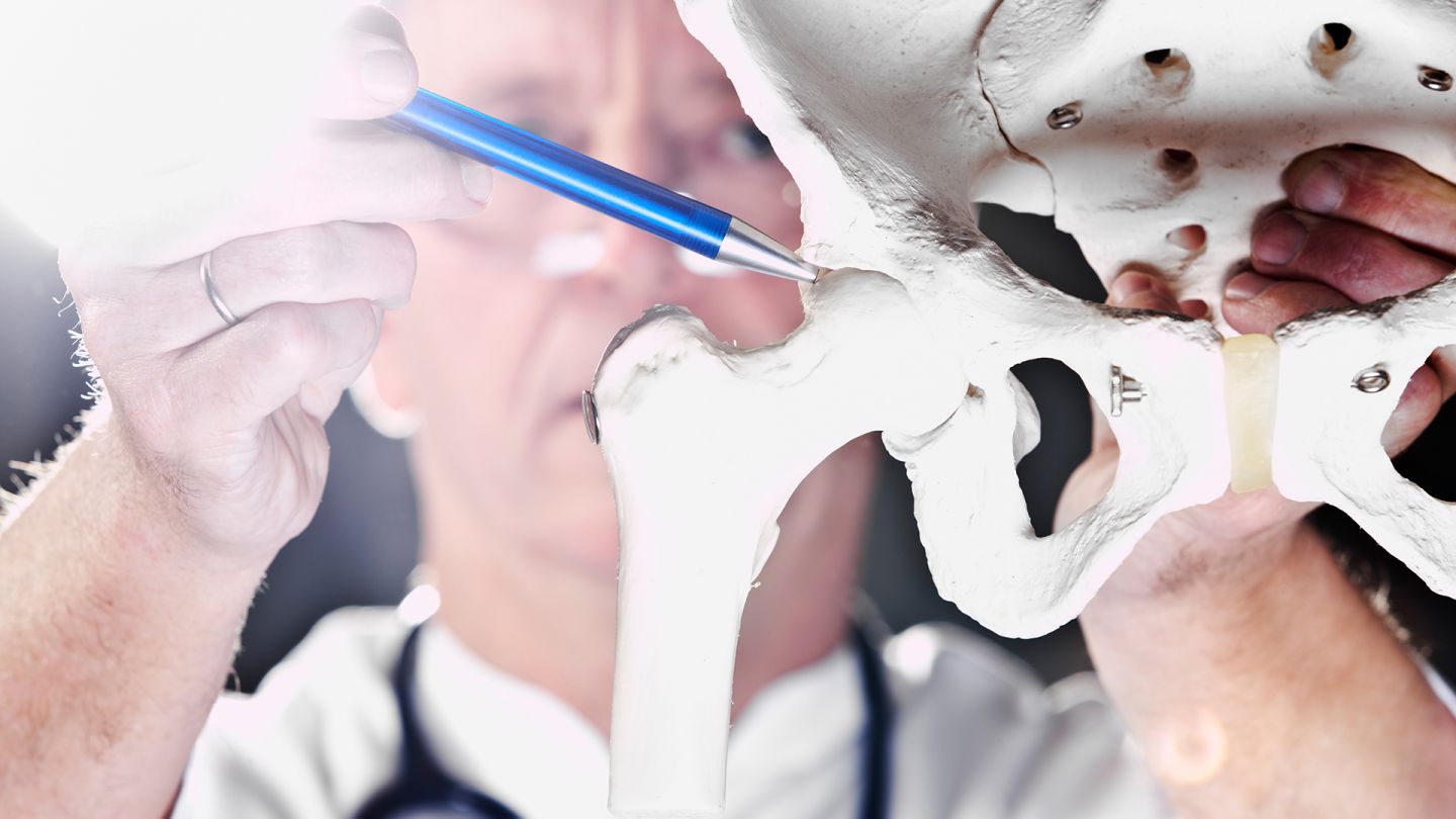 Hüftgelenk (Quelle: Getty Images/Jan Otto) Hüftarthrose: Ein Arzt zeigt mit einem Stift auf den Knochen eines künstliches Gelenkes.