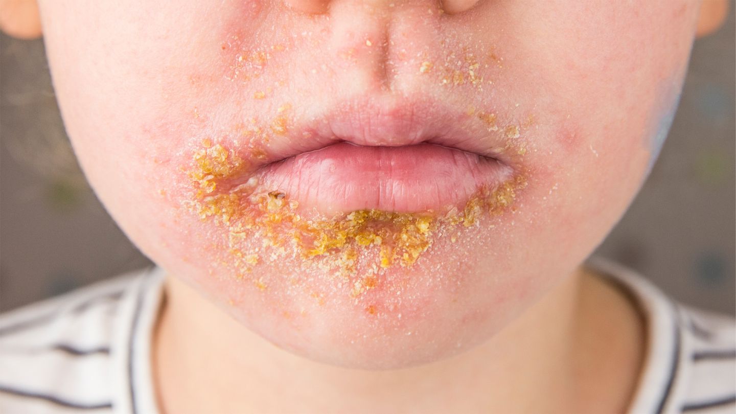 Borkenflechte (Impetigo contagiosa) (Quelle: Getty Images/Helin Loik-Tomson) Impetigo contagiosa: Borkenflechte am Mund eines Jungen.