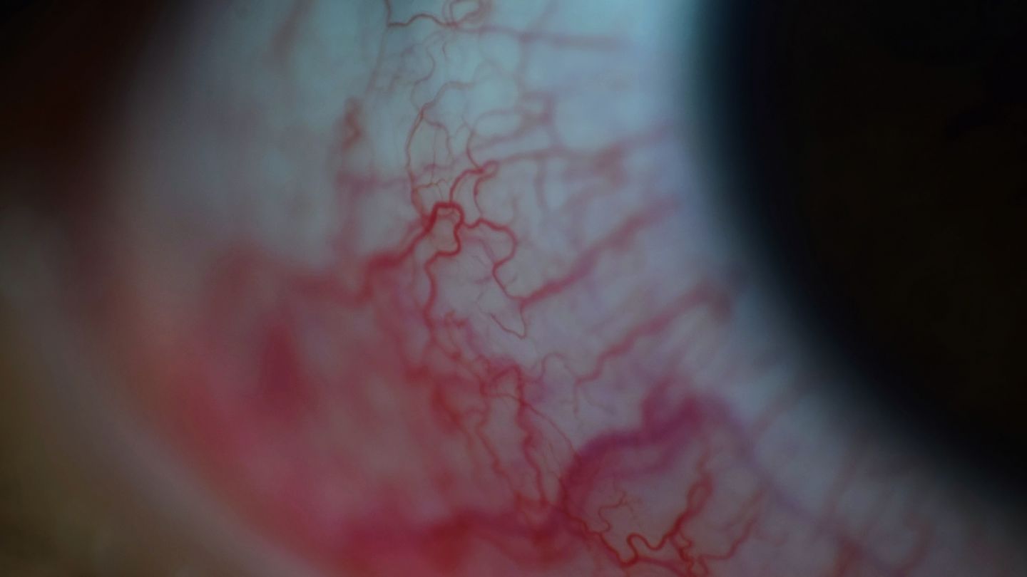 Menschliches Auge (Quelle: Getty Images/Salahuddin Yusuf / EyeEm) Kleine Fremdkörper im Auge: Nahaufnahme eines menschlichen Auges. Deutlich zu erkennen sind zahlreiche feine und rote Blutäderchen am weißfarbenen Augapfel.