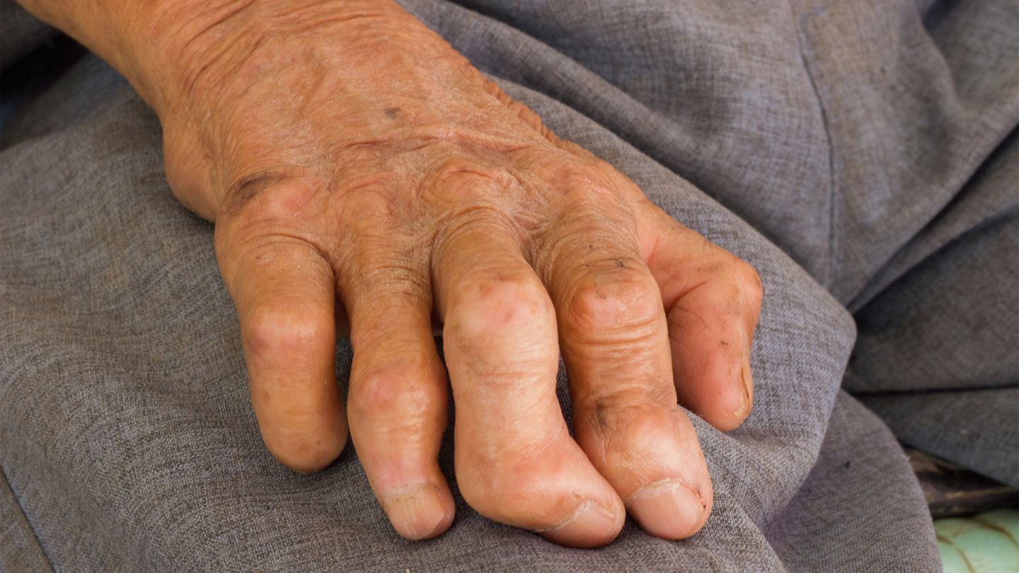 Lepra (Quelle: Getty Images/a3701027) Eine von Lepra gezeichnete Hand liegt auf dem Oberschenkel einer Person. Die Finger der Hand sind deformiert.