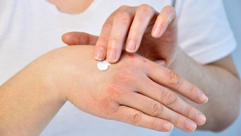 Neurodermitis (Quelle: Getty Images/Cunaplus_M.Faba) Eine Person mit Neurodermitis cremt ihre Hand ein.