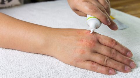 Gereizte Haut (Quelle: Getty Images/Marina Vol) Eine junge Frau hält eine Tube mit Salbe in einer Hand. Sie trägt etwas Salbe auf eine gerötete und leicht schuppige Hautstelle an der anderen Hand auf.
