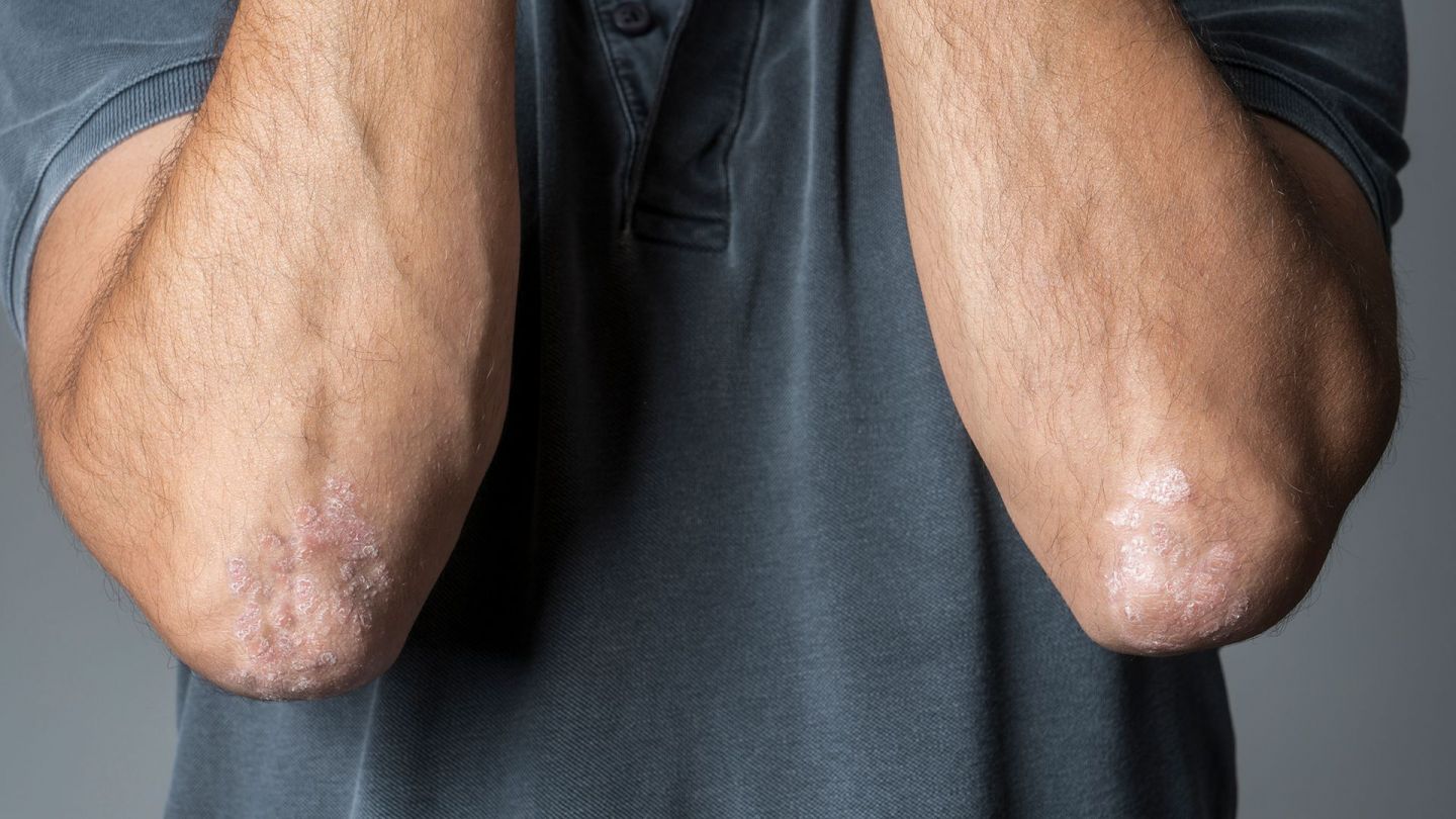 Schuppenflechte am Ellbogen (Quelle: Getty Images/ozgurdonmaz) Psoriasis: Ein Mann beugt seine Arme so an den Oberkörper, dass seine Ellbogen zu sehen sind. An beiden Ellbogen befindet sich Schuppenflechte.