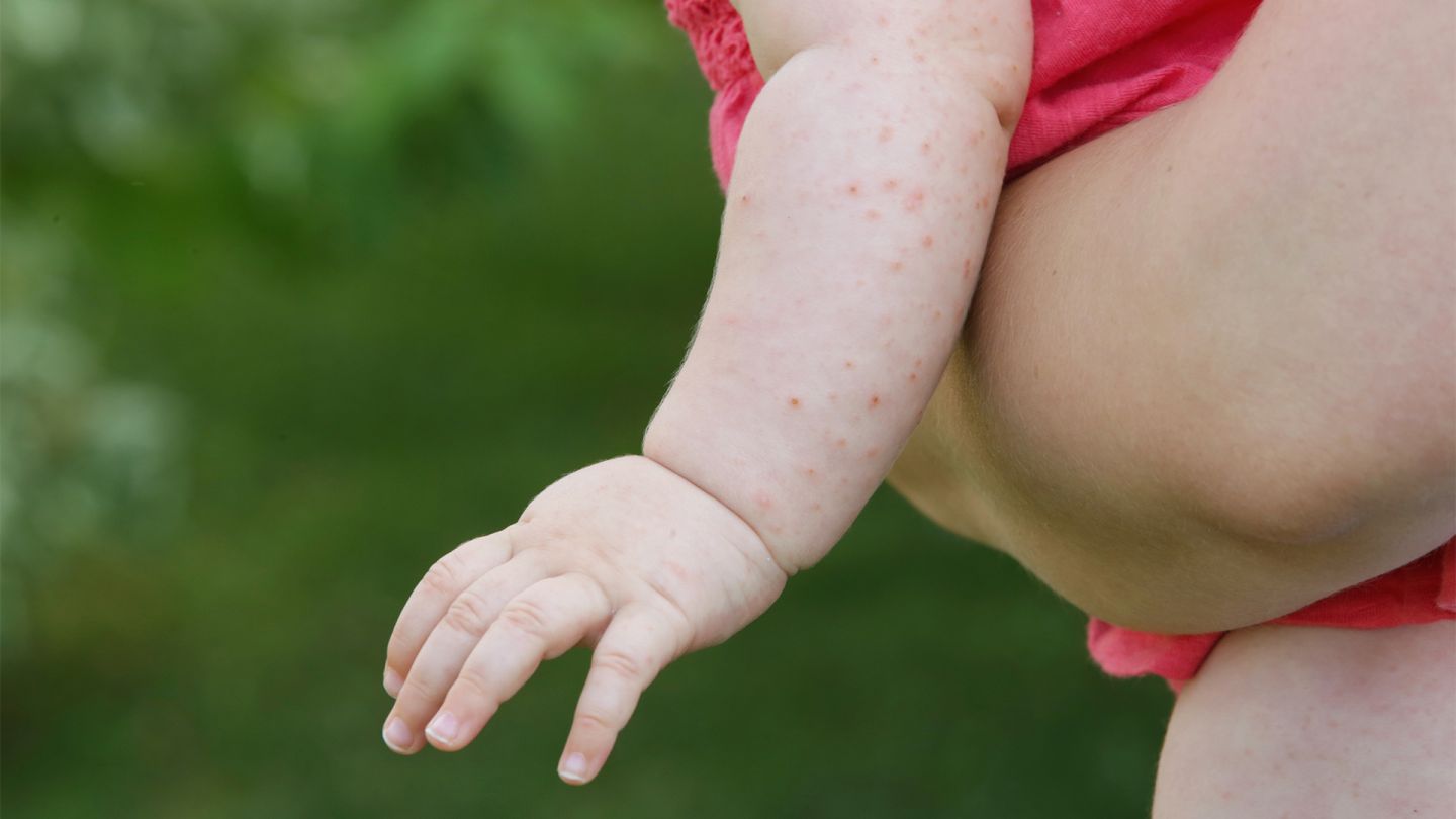 Scharlach Ausschlag (Quelle: istock.com/triocean) Scharlach: Der Arm eines Babys ist von einem roten Hautausschlag befallen.