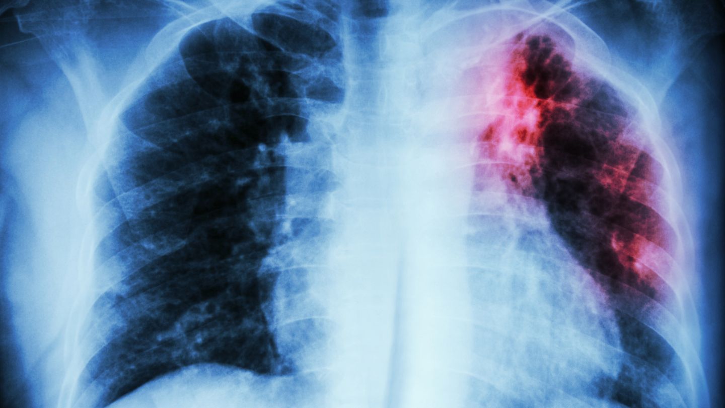 Röntgenbild Tuberkulose (Getty Images/ stockdevil) Tuberkulose: Eine Röntgenaufnahme des Brustkorbs. Eine rot-schwarze Verfärbung im linken Lungenflügel weist auf eine Tuberkuloseinfektion hin.