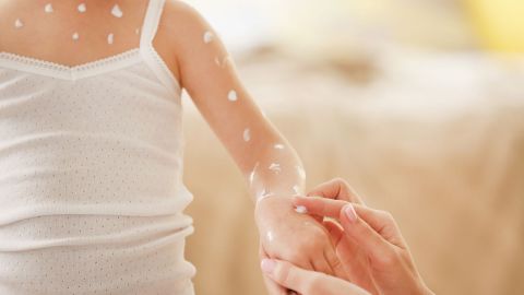 Mädchen mit Windpocken (Quelle: Getty Images/belchonock) Windpocken: Am Brustbein und Arm eines jungen Mädchens sind mehrere Stellen mit Salbe betupft. Eine erwachsene Person cremt weitere Stellen am Handgelenk des Mädchens ein. Unter den eingecremten Hautbereichen befinden sich rote Flecken.