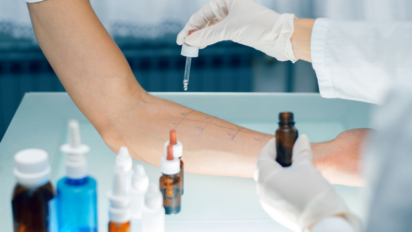 Allergien (Quelle: Getty Images/bluecinema) Allergien: Ein Arzt hält eine Pipette in der Hand und träufelt Flüssigkeit auf den ausgetreckten Unterarm eines jungen Mannes. Der Arm liegt auf einem Behandlungstisch. Auf der Innenseite des Arms sind farbliche Linien und Testfelder aufgezeichnet.