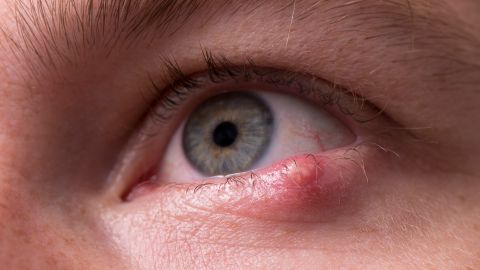 Gerstenkorn: Eitrige Entzündung am Augenlid (Quelle: Getty Images/RuslanDashinsky) Ein Gerstenkorn haftet an einem Augenlid.