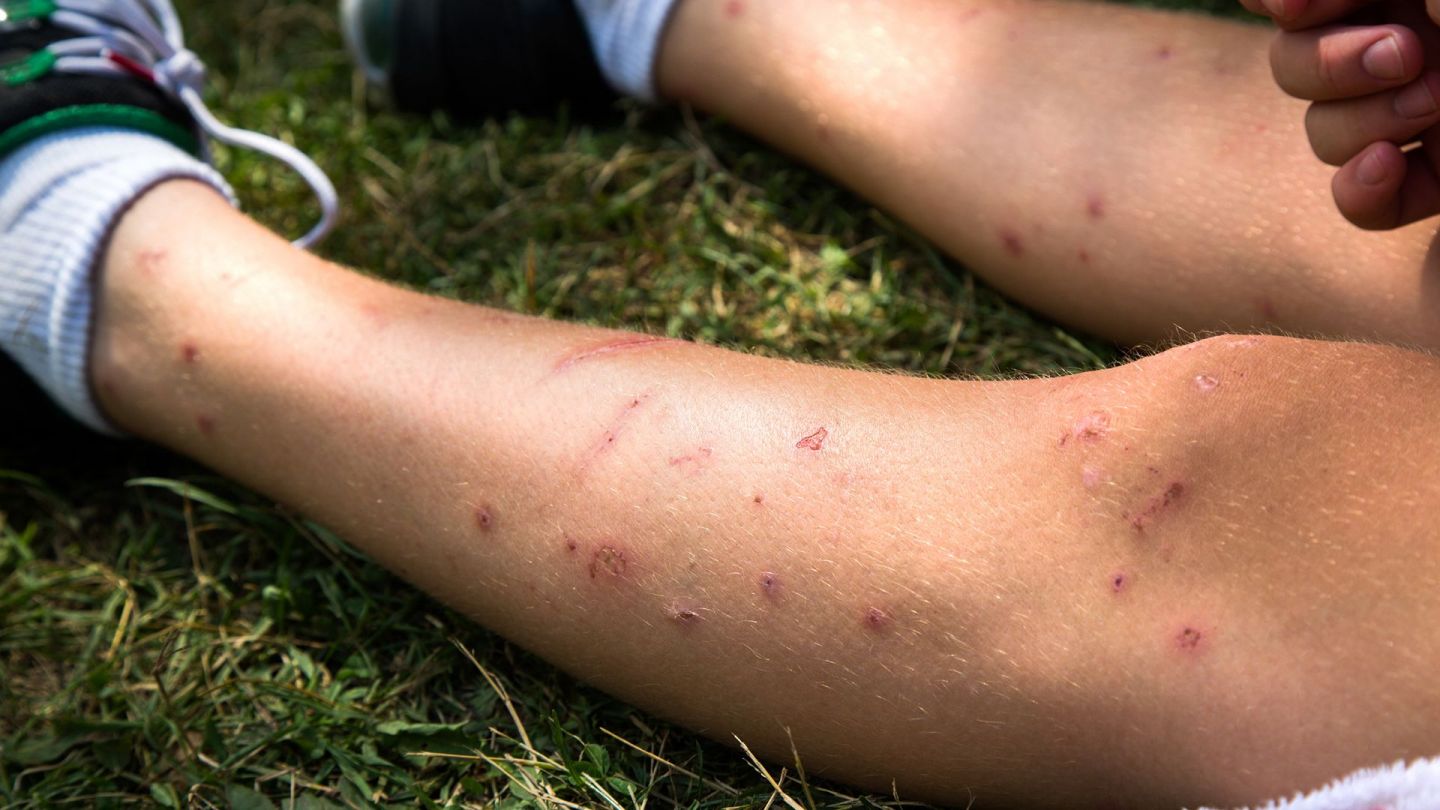 Stiche von Insekten (Quelle: Getty Images/Steven_Kriemadis) Insektenstiche: Die Beine eines jungen Menschen, der auf einer Wiese sitzt, haben an mehreren Stellen Einstiche sowie teilweise Wunden und Kratzspuren.