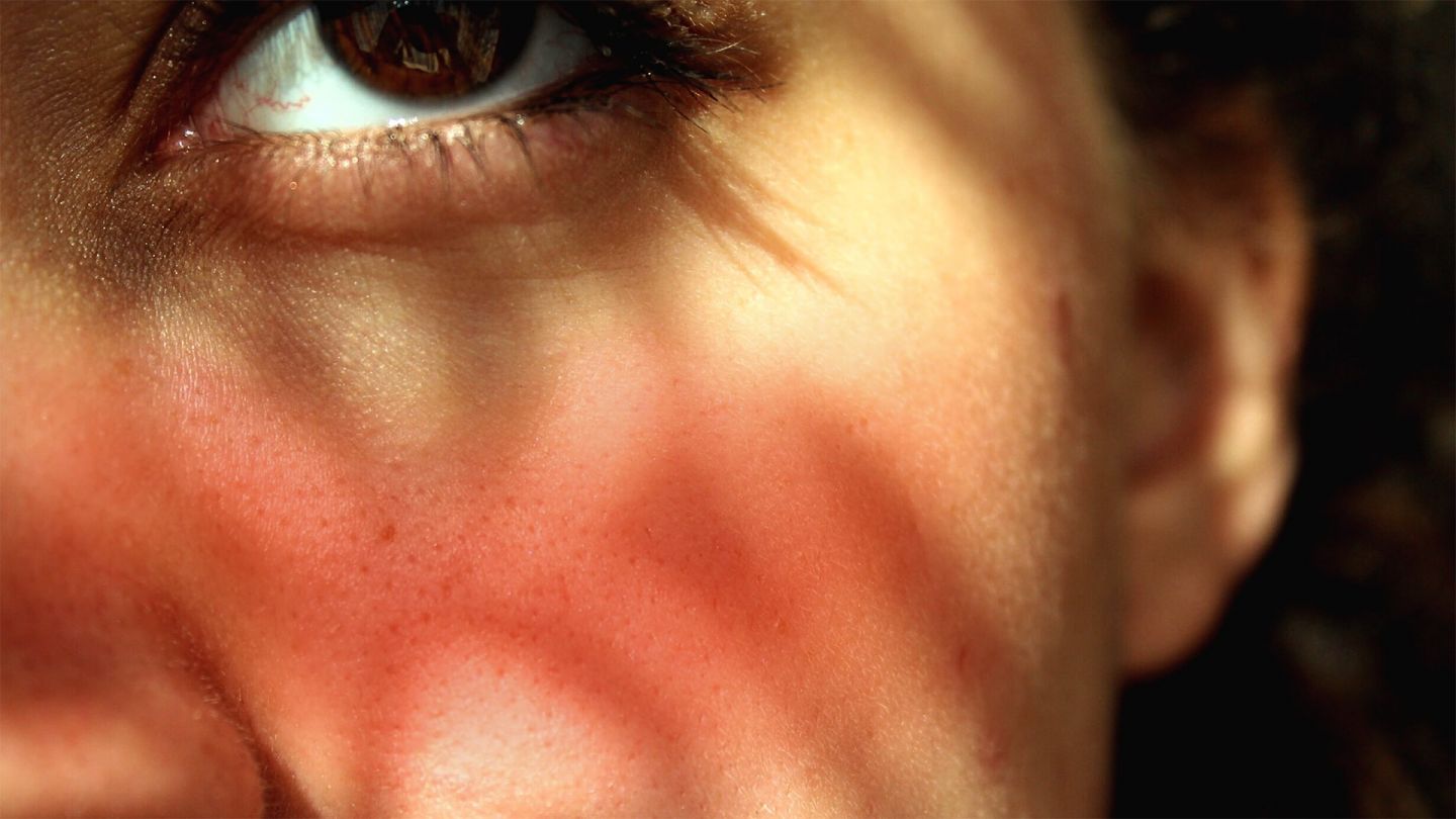 Wange und Auge einer Frau (Symbolbild) (Quelle: Getty Images/Tiarna Lodge / EyeEm) Rosazea: Die Wange einer Frau ist leicht geörtet. In ihrem Auge sind rote Äderchen zu sehen.